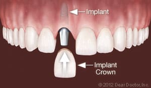 implants-replace-one-tooth