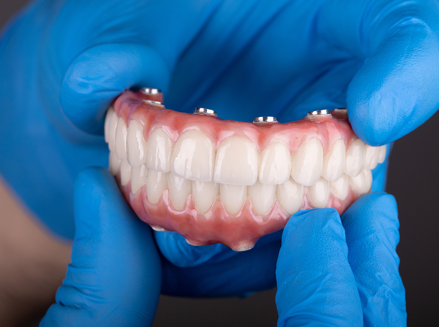 All-On-X Permanent Teeth