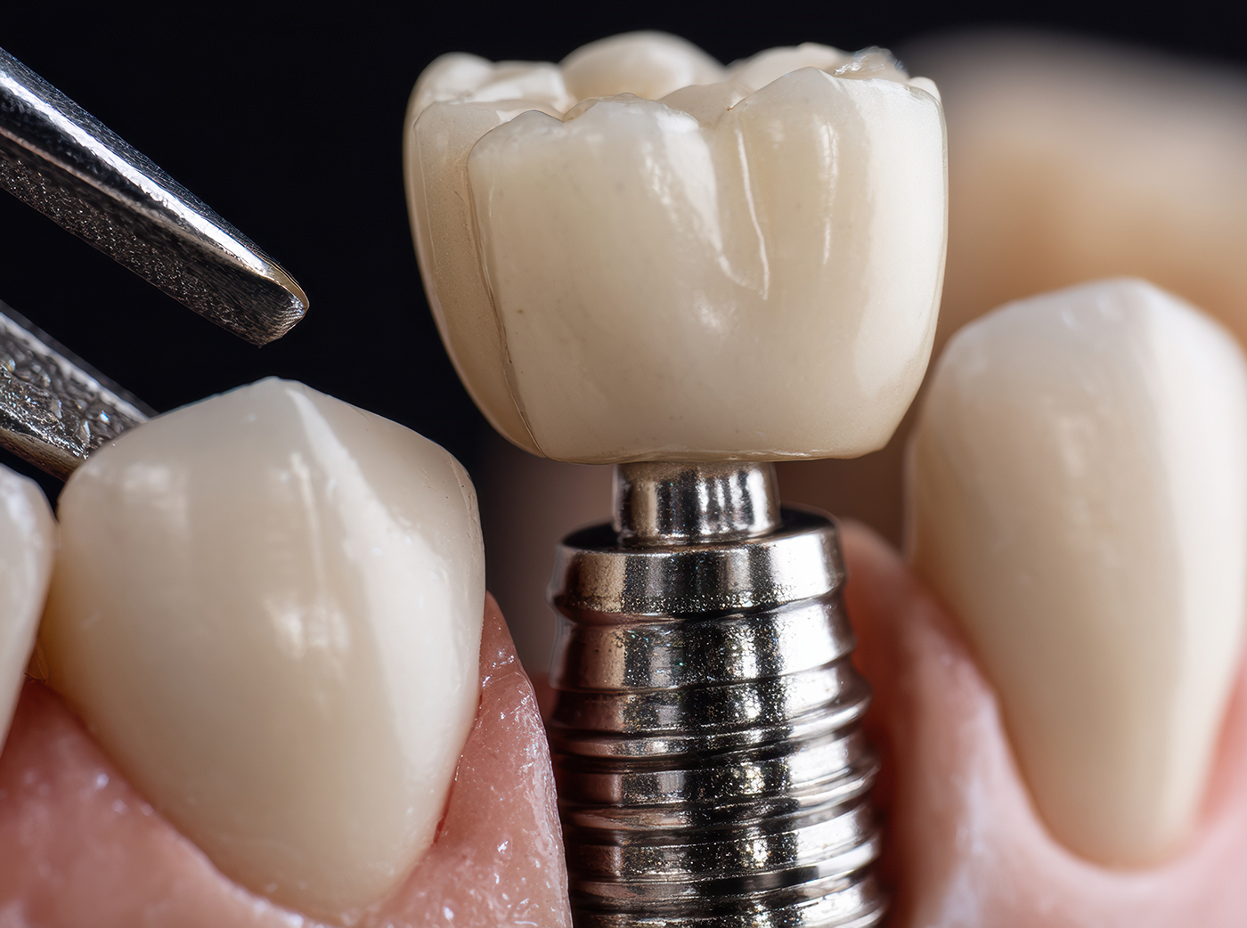 Close-up View of a Dental Implant Procedure With Porcelain Crown Placement Showcasing Modern Restorative Techniques in Dentistry Generative AI