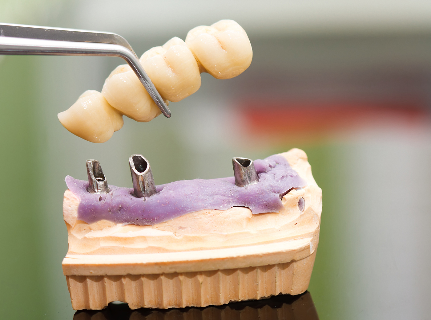 Dental implant head and bridge