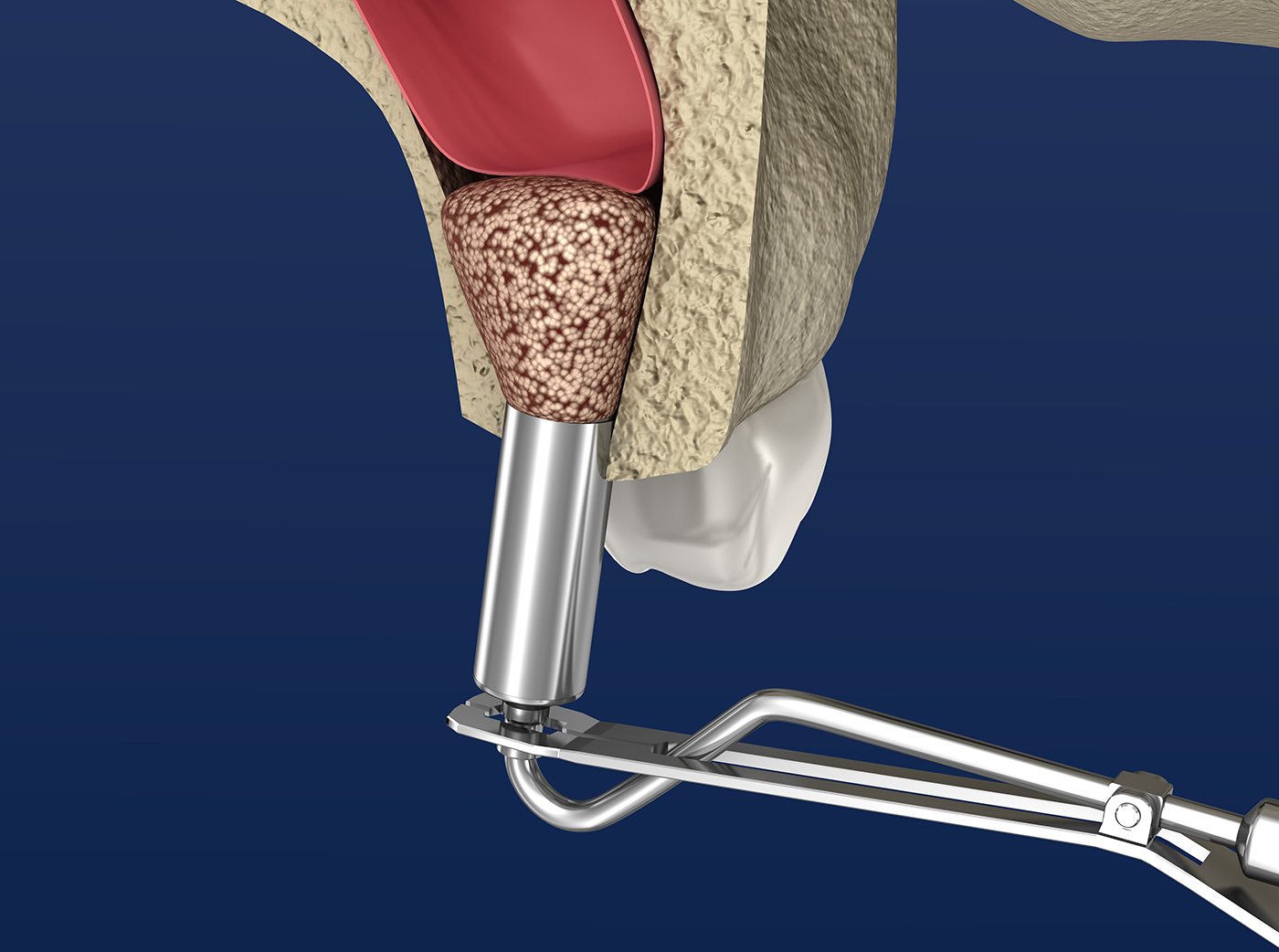 Sinus Lift Surgery