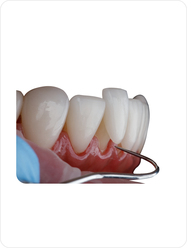 Ultra Thin tooth Veneers
