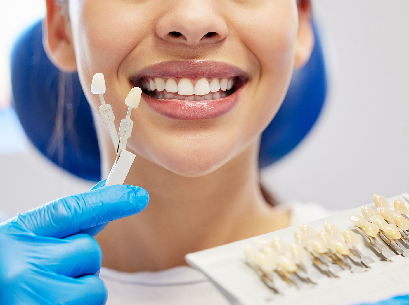 dental veneers with tooth shades beside white teeth