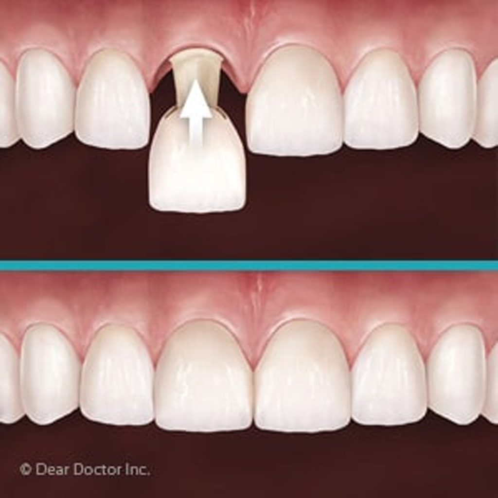 Customized Temporary Crowns Help Ensure A Satisfying Permanent Smile