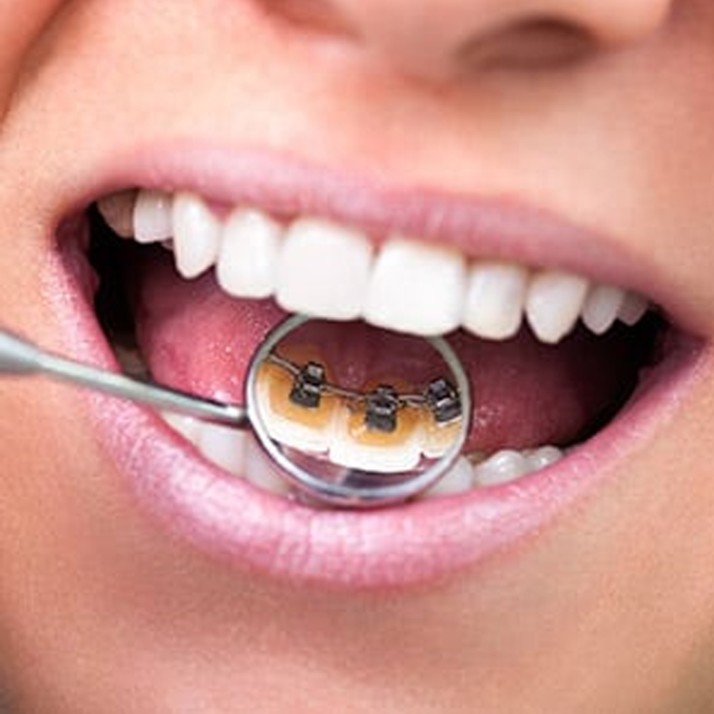 Lingual Braces: A Third Choice For Moving Teeth