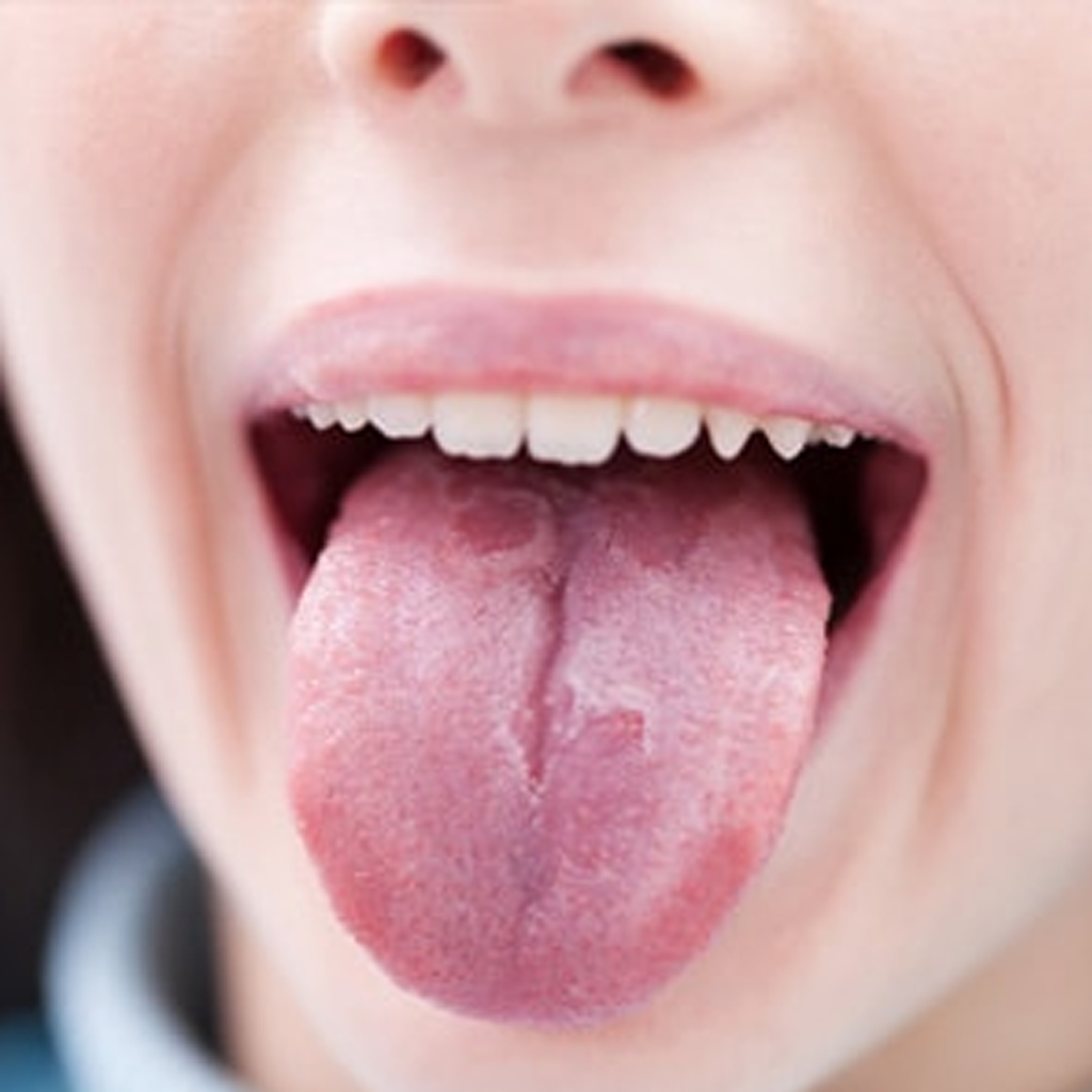Those Red Patches On Your Tongue Are Nothing To Be Alarmed About