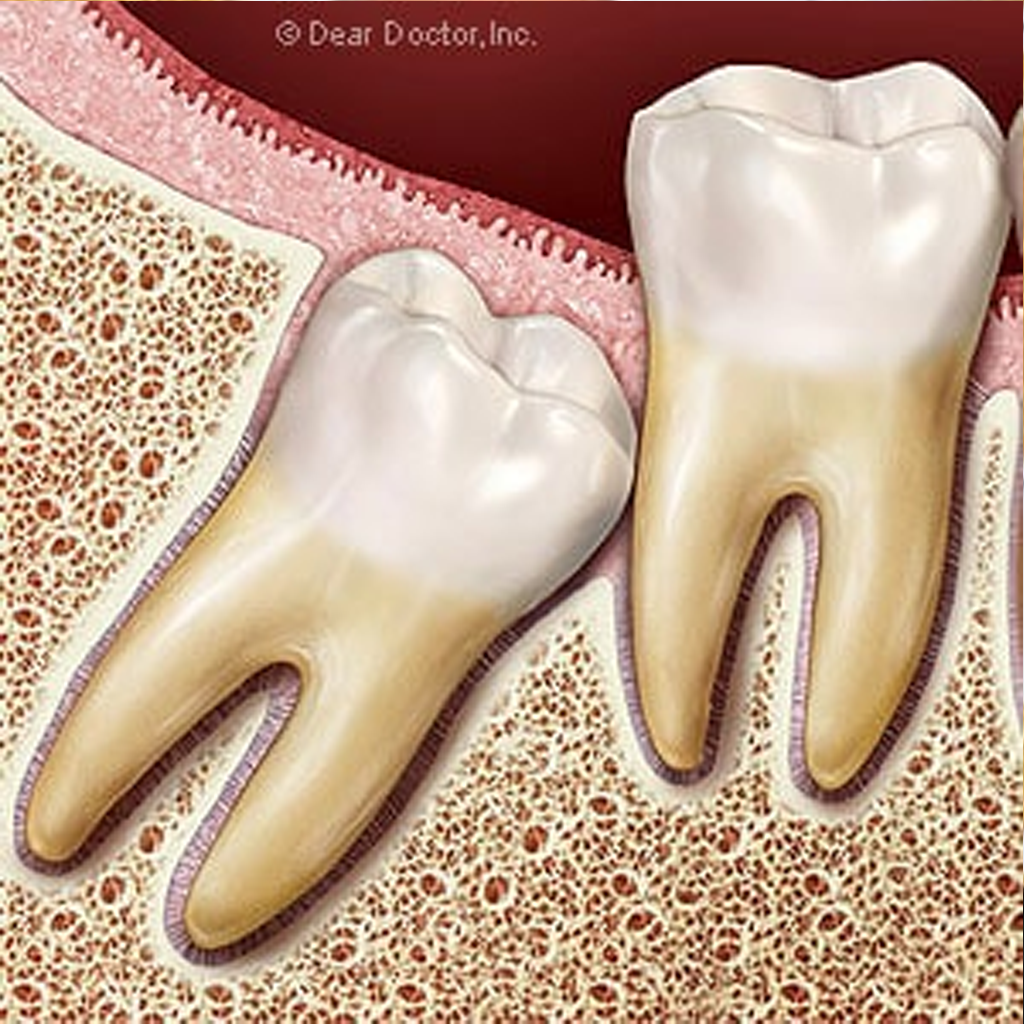 Wisdom Teeth Warrant Close Watch To Avoid Future Health Issues